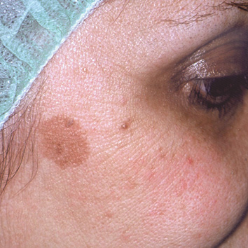 Remoção de Lesões Benignas e Hiperpigmentações - BioMulher - centro de tratamento e diagnóstico